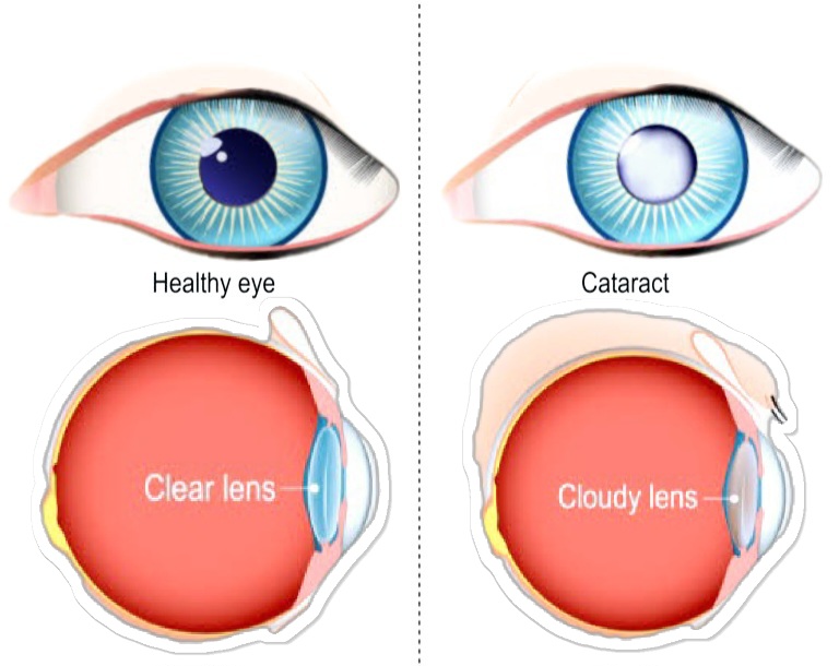 normal vs cataract eye